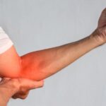Cubital Tunnel Syndrome